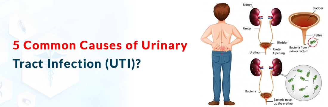  5 Common Causes of Urinary Tract Infection (UTI)?